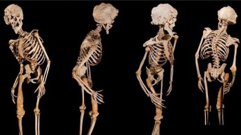 (Original-Skelett in Queen Mary University of London Medical School)