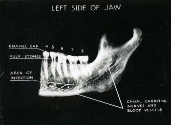 Röntgenaufnahme des linken Kiefers,<br />gefunden bei den Ausgrabungen im Keller<br />(© foxearth.org.uk)